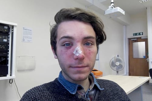 Cambridge, studente romano pestato da una baby-gang: "Ma non porto rancore"