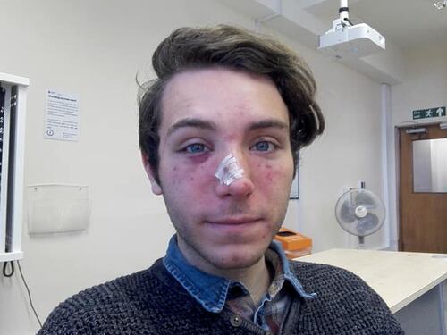 Cambridge, studente romano pestato da una baby-gang: "Ma non porto rancore"