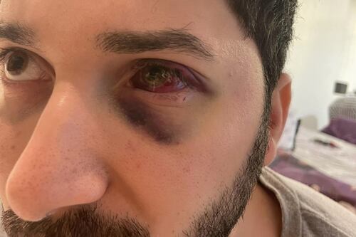 Massacrato a colpi di mazza da baseball, il pub diventa un inferno
