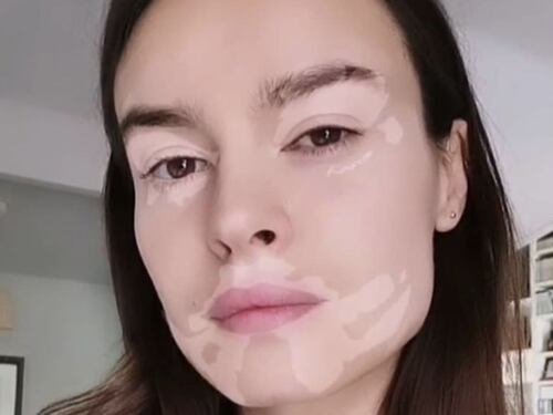 Kasia Smutniak dopo la vitiligine. Così inventa il filtro della diversità