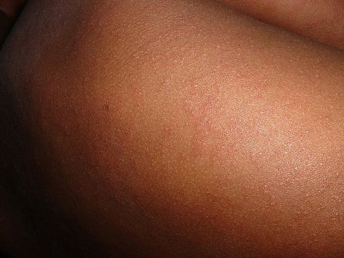 Morbillo, scatta l’allerta per la nuova variante in Italia: “Sfugge ai test”