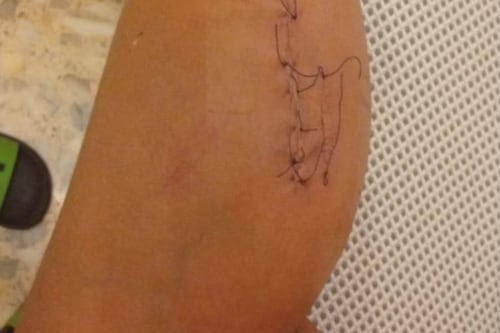 Ferita con una bottiglia rotta da uno straniero fuori di testa. È ancora libero