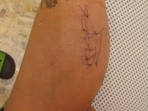 Ferita con una bottiglia rotta da uno straniero fuori di testa. È ancora libero
